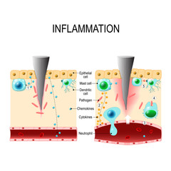 Wall Mural - Inflammation. Immune system