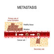 Cancer cells squeezes through blood vessel during Metastases