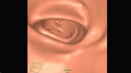 Sticker - CT colonography is highly sensitive for colorectal cancer, Show 3D rendering image  inside  the colon. realistic colon.