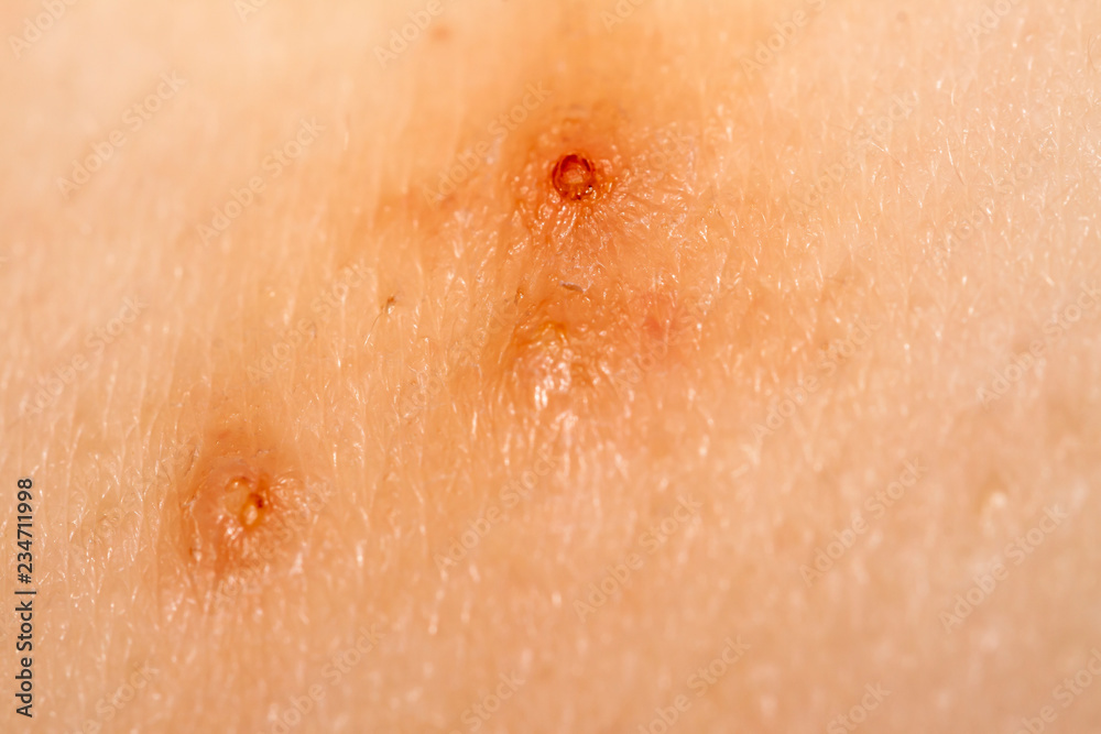 Close up of Molluscum Contagiosum also called water wart
