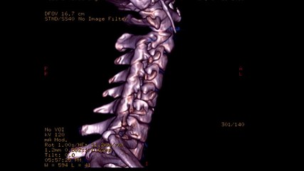 Poster - CT SCAN of Cervical Spine ( C-spine ) patient trauma case  3D rendering image  Rotating on the monitor . Medical technology concept.