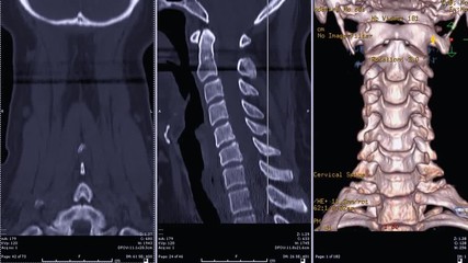 Poster - CT SCAN of Cervical Spine ( C-spine ) patient trauma case coronal plane vs sagittal plane and 3D rendering image  Rotating on the monitor . Medical technology concept.