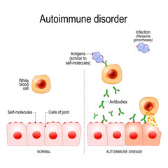 Wall Mural - Autoimmune disorders