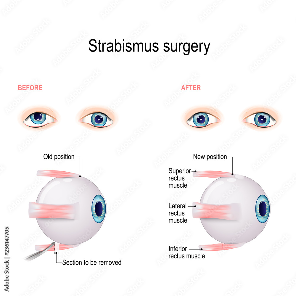 Strabismus Surgery. Hypertropia. Eye muscle recession. Stock Vector | Adobe  Stock, image size:1000x1000