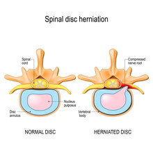 Normal Disc And Spinal Disc Herniation In Cervical Vertebrae.