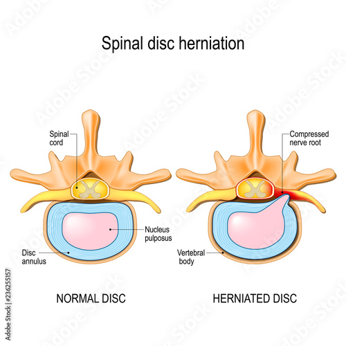 Fotomural Normal disc and spinal disc herniation in cervical vertebrae.
