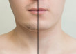 © Асель Иржанова - The result on the mans face after shaving, before and after. Effect of after shave cream. Hair transplantation on the beard. Close-up