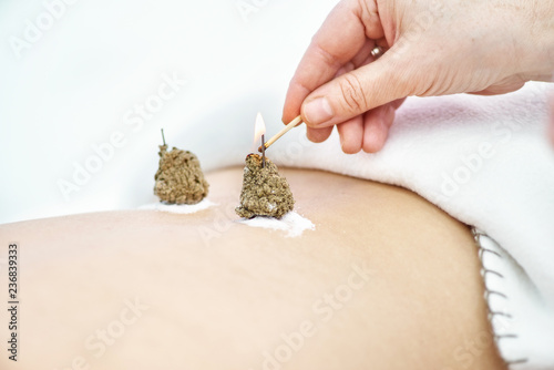 Cuadros en Lienzo Woman being treated with acupuncture and moxibustion treatments