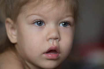 child with runny nose