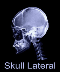 Poster -  x-ray image of Human skull  Lateral view or side view isolated on Black Background. Clipping path