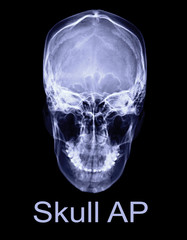 Poster -  x-ray image of Human skull  AP view or front view isolated on Black Background. Clipping path