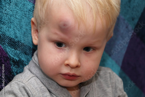 Fotografie, Obraz A big bruise on the forehead of a little boy