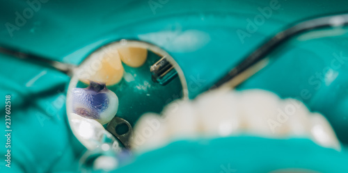 Fotografie, Obraz Ceramic front crowns, green background. 8 units dental veneers