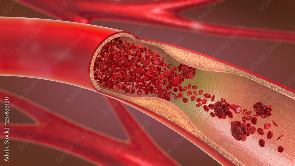 3d illustration of a constricted and narrowed artery and the blood cannot flow properly called arteriosclerosis - obrazy, fototapety, plakaty 