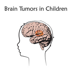 Brain tumors, cancer in infants, childhood. Vector medical illustration. Kid, baby, childhood. White background, line silhouette of child head, anatomy flat image.