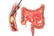 Illustration of colonoscope in the colon during a colonoscopy procedure. GI Endoscopy 