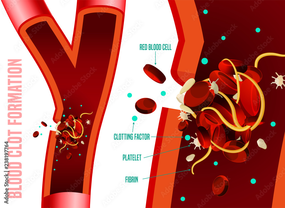 Blood clot formation Stock Vector | Adobe Stock