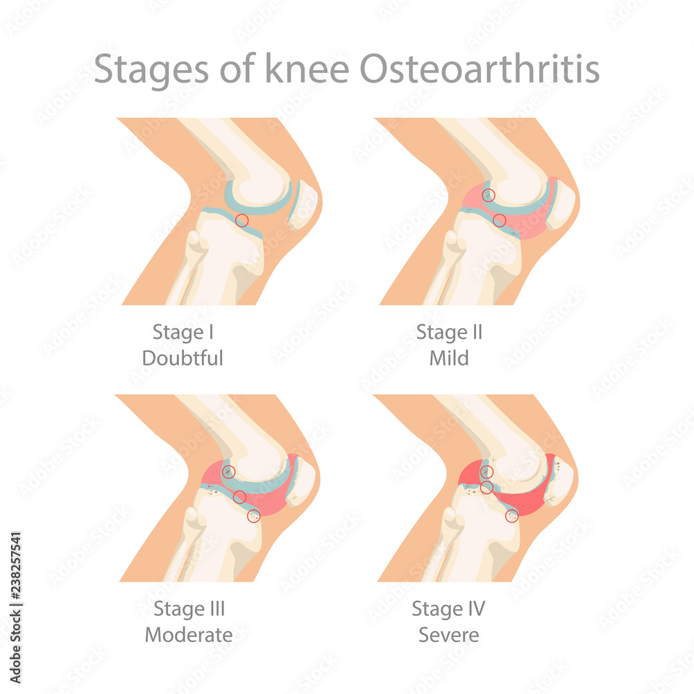 Stages of knee Osteoarthritis. Human Knee Osteoarthritis infographics ...