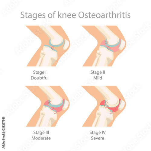 Stages of knee Osteoarthritis. Human Knee Osteoarthritis infographics ...