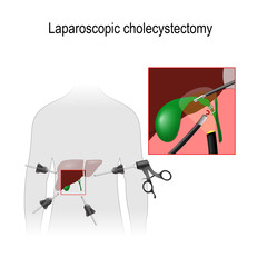 Wall Mural - Laparoscopic Cholecystectomy