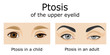 Illustration of Ptosis of the upper eyelid