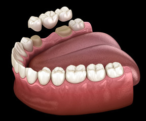 Dental bridge of 3 teeth over molar and premolar. Medically accurate 3D illustration of human teeth treatment