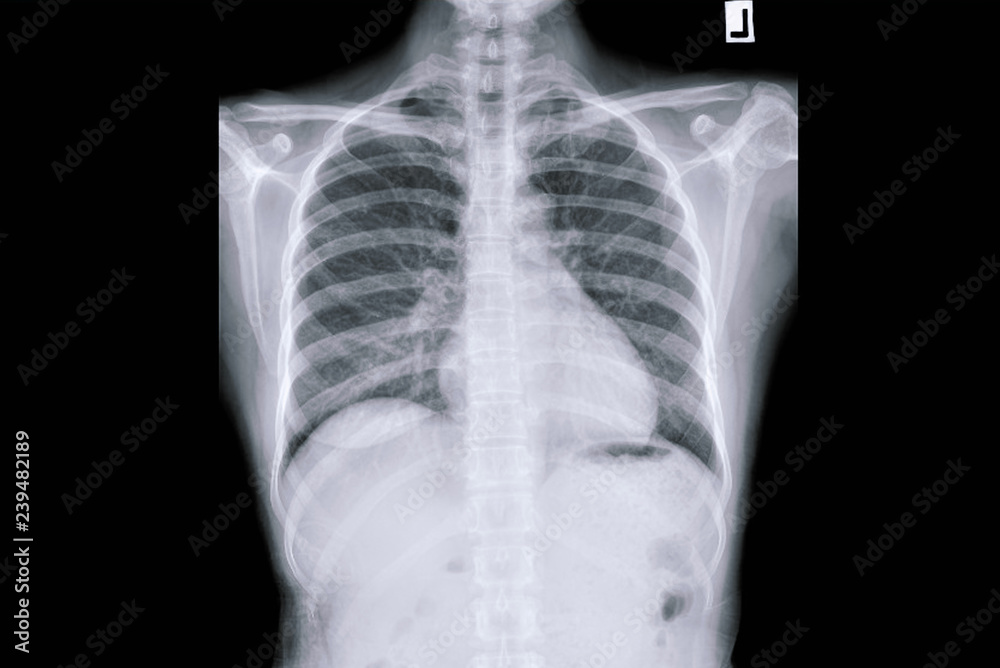 Chest radiograph, Chest x-ray, CXR of COPD patients. Stock Photo ...