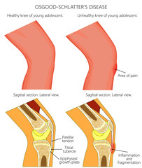 Vector illustration of a healthy adolescent knee and unhealthy knee with Osgood schlatter disease. Anatomy of human knee, external view and lateral view of  sagittal section of the knee.