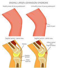 Vector illustration of a healthy adolescent knee and unhealthy knee with Sinding Larsen Johansson syndrome. Anatomy of human knee, external view and lateral view of  sagittal section of the knee.