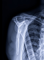 Poster - Radiographic image or x-ray image of Shoulder joint. additional view name is supraspinatus outlet