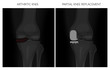 Vector illustration. Anatomy, front x-ray of an arthritic knee joint and a knee after unicompartmental or partial  knee replacement. For advertising and medical publications