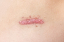 Close Up Of Cyanotic Keloid Scar Caused By Surgery And Suturing, Skin Imperfections Or Defects. Hypertrophic Scar On Skin, Dermatology And Cosmetology Concept