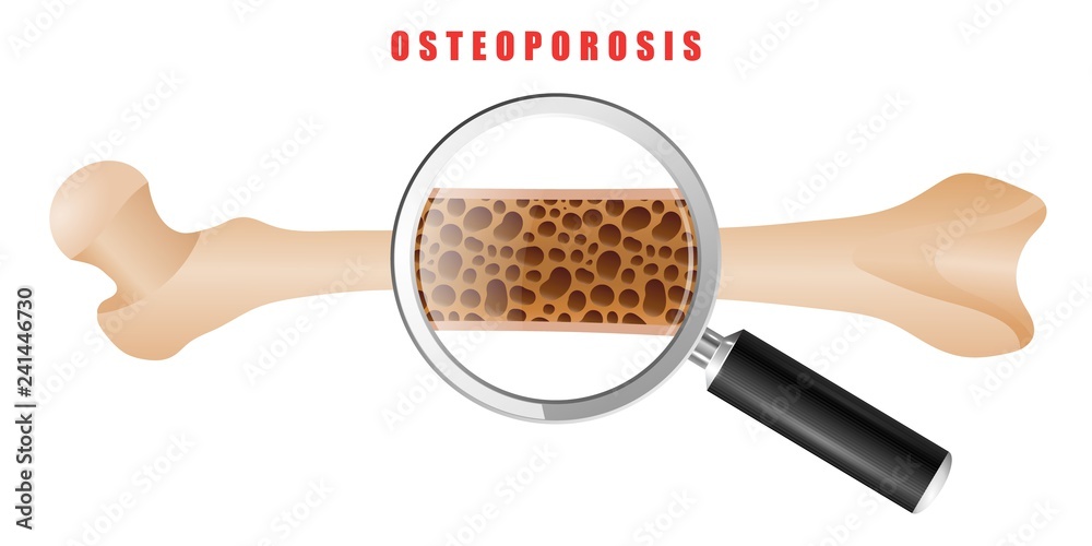 Color drawing of human thigh bone with osteoporosis problem on white background. Two bones are normal and sore. Vector illustration of the medical problem of osteoporosis disease - obrazy, fototapety, plakaty 