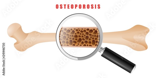 Cuadros en Lienzo Color drawing of human thigh bone with osteoporosis problem on white background