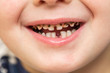 Kid patient open mouth showing cavities teeth decay. Close up of unhealthy baby teeth. Dental medicine and healthcare - human patient open mouth showing caries teeth decay