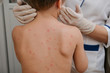 © natus111 - Doctor examines baby's skin full of blisters,scar and rash caused by chickenpox