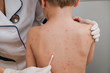 © natus111 - Doctor applying cream to baby's skin with blisters and rash caused by chickenpox