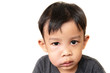 © Asada - swollen face  of asian kid suffering from health problem and aching tooth, showing dissatisfaction. dental concept.