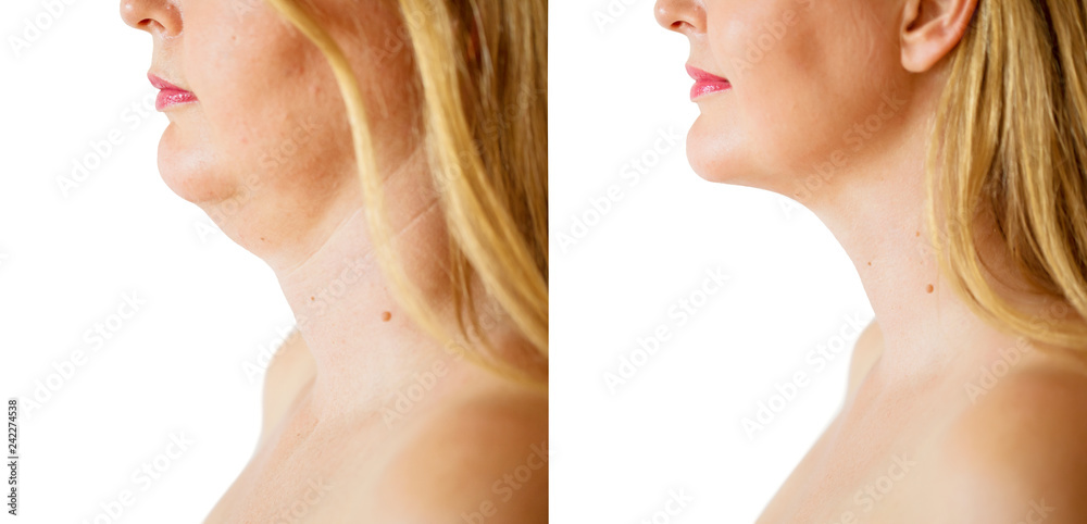 Woman before and after chin fat correction procedure - obrazy, fototapety, plakaty 