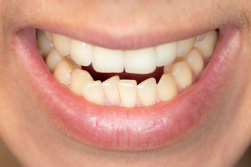 Crowding of the teeth of the lower jaw of a young caucasian man