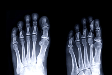 Poster - Gouty arthritis . film x-ray of left toe front and oblique view.