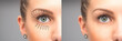 Leinwandbild Motiv Female eyes before and after blepharoplasty