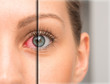 Red eye before and after eyedrop treatment