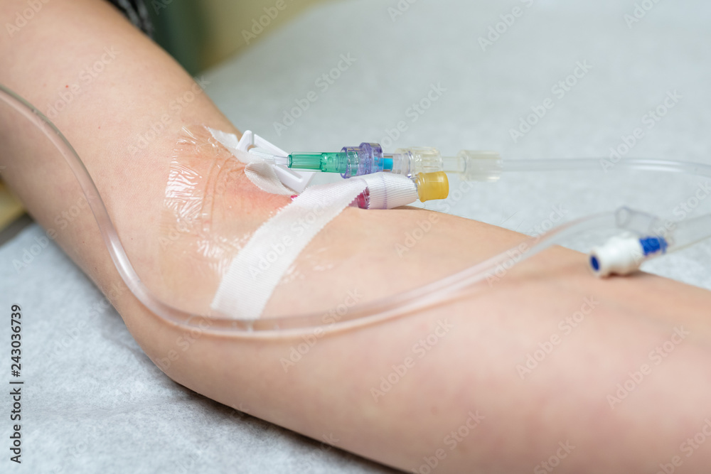 Young adult female arm with intravenous injection at the emergency room ...