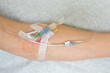 Young adult female arm with intravenous injection at the emergency room.