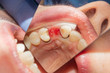 restoration of teeth after endodontic treatment with fiberglass pins. The concept of aesthetic orthopedic dentistry