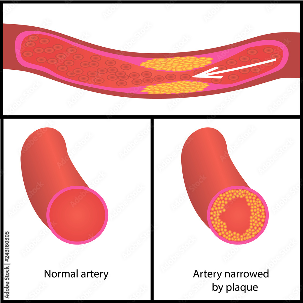 Levels of cholesterol plaque in vessels Stock Vector | Adobe Stock