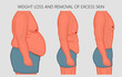 Vector illustration. Human body problem after Weight loss, excess skin  removal in man. Side view. For advertising of cosmetic plastic procedures, for medical publications