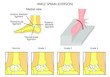 Mechanism of formation of an ankle sprain and Grades of an ankle sprain (Eversion) illustration with external and skeletal (medial) view