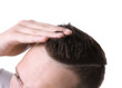 Man with hair loss problem on white background, closeup